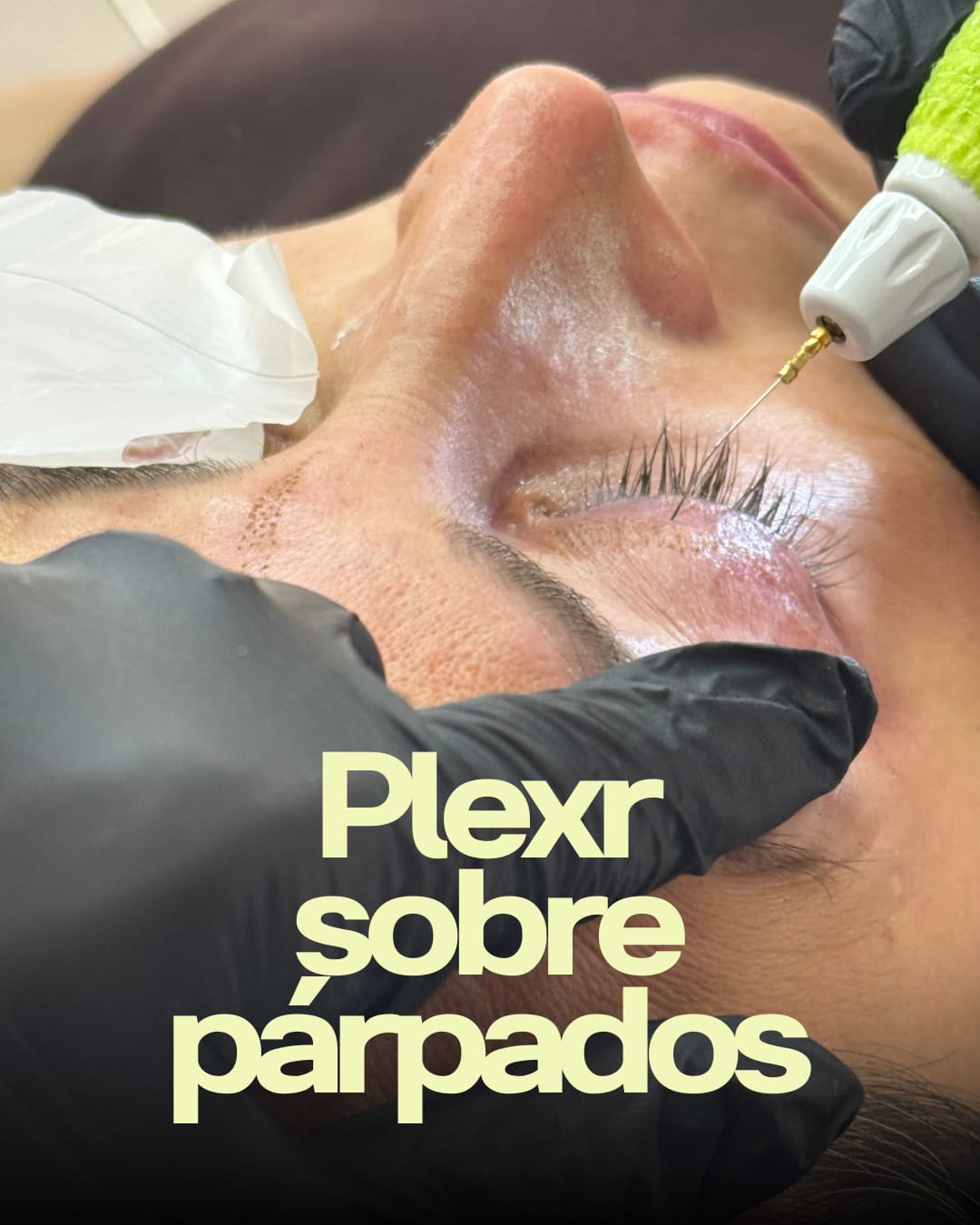 Aplicación de Plexr sobre el párpado
